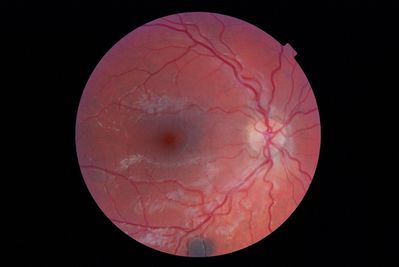 suspicious nevus? Jan 2012
Jan 2012 - see other 2 pics.
