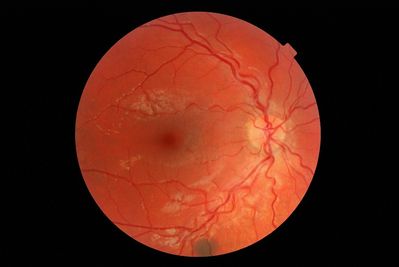 suspicious nevus? Jan 2011
Jan 2011 - see other pics. http://theoptom.com/viewtopic.php?t=21824
