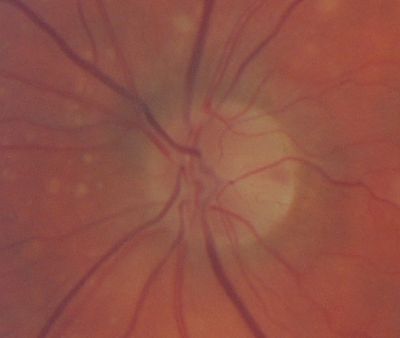 CRAO caught 30mins after occurrence
Note the vessel empty of blood
