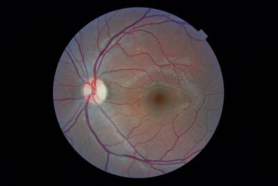 Posterior Eye Icon
Posterior Eye Icon - TheOptom's eye. (Topcon NW6)

