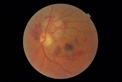 juxta papilary subretinal neovascular membrane
confirmed at HES by OCT. Treated with intravitreal bevacizumab/avastin x3
Keywords: subretinal;neovascular;membrane;avastin