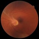 LE-fundus.jpg