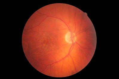 Dry ARMD
Taken with Canon CR-1 (Mark II)
