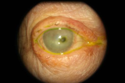 ?Iris Prolapse thorugh a full thickness corneal perforation
