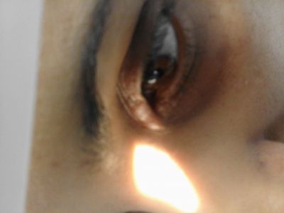 Lid problem? 2nd picture. Superior lid
40 yr old female px concerned about recent onset of lid lump.
Dx as chalazia by nurse @ GP surgery. Slit lamp reveal hard lumpy mass - most probably chalazia but not the typical presentation.
What do you think it might be? Px is a concerned asymptomatic- management? To refer or not to refer.
Px wants ideally referral.
