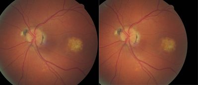 Best Disease LE
Scrambled egg appearance 6/60
