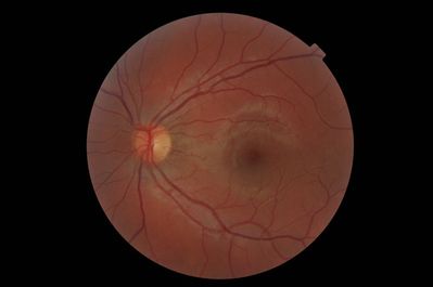 +0.50Ds LE
asymptomatic 18yo female at first eye test
