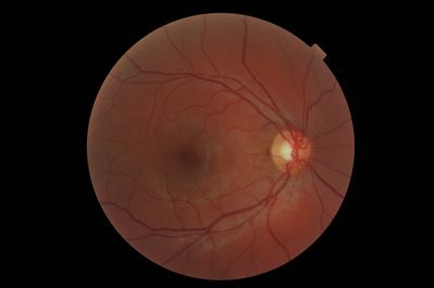 +0.50Ds RE
asymptomatic 18yo female at first eye test
