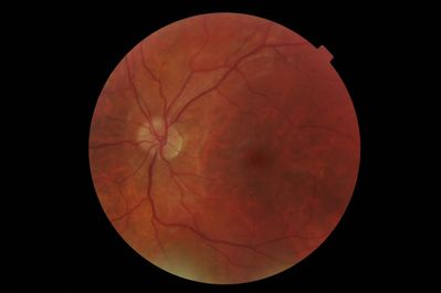 congenital tilted discs?
27yo female Type A patient, both parents have had brain haemorrhages, very concerned about health
no-one has ever commented on her disc appearance before
approx -4.50/-1.50 R&L
VA 6/6+
fields full
