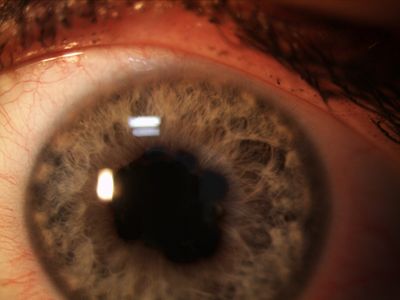 Synechiae
first epsiode of AAU, could not break synechiae with CYC
