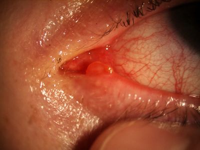 canalicular granuloma following permanent punctal plugs
post laser surgery Px with dry eyes had permanent intracanalicular plugs fitted in 2003 - asymptomatic at present, granuloma discovered when removing metal FB from cornea
