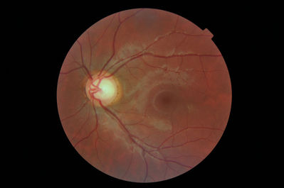 ?physiological cupping
16yo Caucasian female +0.50 R&L full fields and normal IOPs
