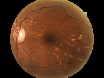 retinal photo left eye
