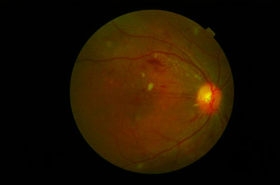 Grade 2.5 Hypertensive Retinopathy 2
Keywords: Hypertension, Retinopathy, Macualar Oedema