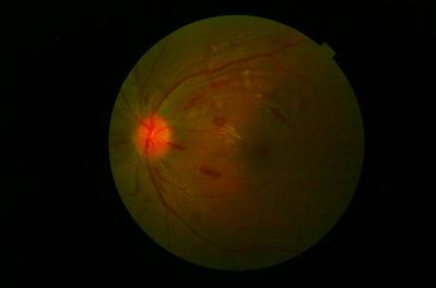 Grade 2.5 Hypertensive Retinopathy 1
Keywords: Hypertension, Retinopathy