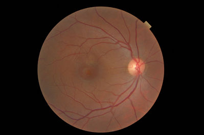 Central Serous Retinopathy
Male 39 reported "shadow" in right eye for 5 weeks. VA 6/6 & N5. Referred and seen within 4 days. 
