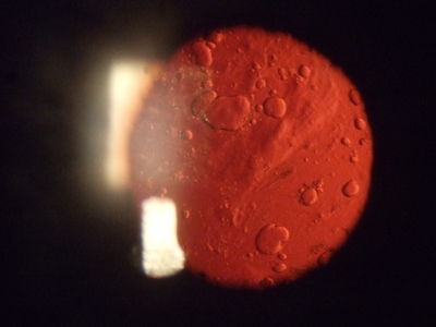 Posterior sub capsular thickening
History of retainal deatchment surgery followed by cataract surgery a year ago. VA now down to 6/12.
Taken using fuji finepix f30 hand held camera against slit lamp eyepiece.
