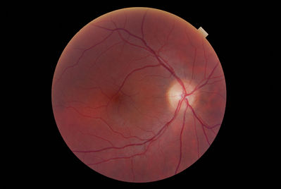 Macula Blood vessel
Unusual course of bv across macula. VA 6/6. Longstanding. 
