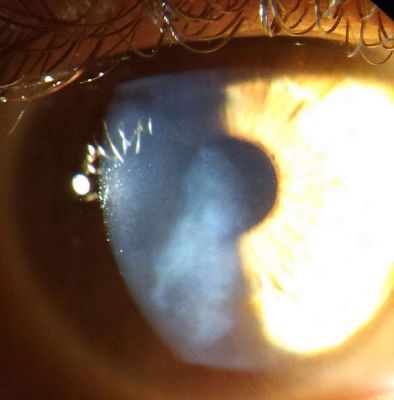 Presumed acanthamoeba keratitis
This was a patient I saw this week.  About 10 years ago he had a severe corneal insult, aet 14yrs.  He admits to having abused his contact lens wear at the time, ended up taking three weeks to have a confirmed diagnosis and ended up being treated very aggressively with topical meds being created by the hospital's compounding pharmacy.  This leads me to suspect it was an acanthamoeba keratitis.
Keywords: acanthamoeba keratitis