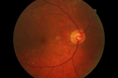 Background Diabetic Retinopathy
10 year diagnosed Type II.

Lots going on.

Taken with a Canon CR-6
