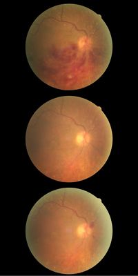 Branch Retinal Vein Occlusion
Original occlusion in 2009, middle photo earlier this year.  New symptoms started two days ago and new photo at the bottom.

Taken with a Canon CR-1 Digi
