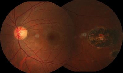 CHRPE
CHRPE mosaic photo taken with a Canon CR-6 using Synemed software.
