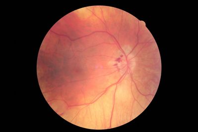 Disc haemorrhages
Disc haemorrhages.  Taken with a Canon DG-1
