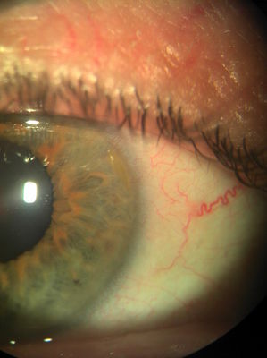 A photo taken by Homer
Something near the limbus, who knows what!
