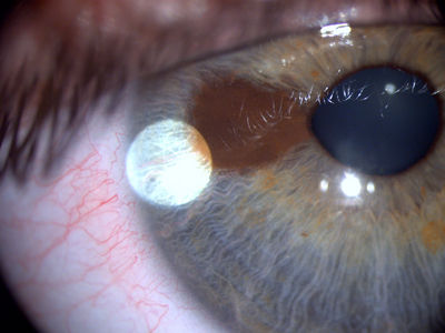 Iris pigmentation
Interesting looking iris pigment with associated vessels, reportedly long-standing. Taken with a Topcon DC-1.
