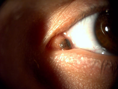 Naevus
Taken with a Topcon DC-1
Keywords: Naevus, caruncle