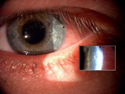 Skidoo in the eye
Okay, not the whole Skidoo, however metal FB in the superficial cornea, been there for ~3 days just nice and easy to take out today.  Taken with a Topcon DC-1.
