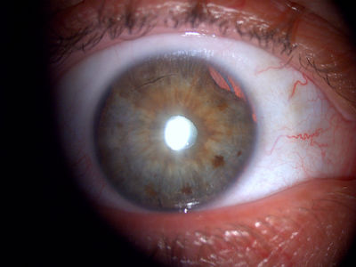 Trauma injury showing iris root detachment
Trauma injury showing iris root detachment.  Injury from 20 years ago, has had phaco/IOL.  You can see some of the retro-illumination creeping back through the iris root.  Taken with a Topcon - DC1.
Keywords: iris transillumination defect; iris root; trauma