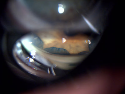 Trauma injury showing iris root detachment - Superior angle gonio view
Trauma injury showing iris root detachment.  Injury from 20 years ago, has had phaco/IOL.  Superior angle viewed with a Goldmann 3-mirror goniolens.  Taken with a Topcon - DC1.
Keywords: Gonioscopy; goniolens; gonio; iris root; trauma