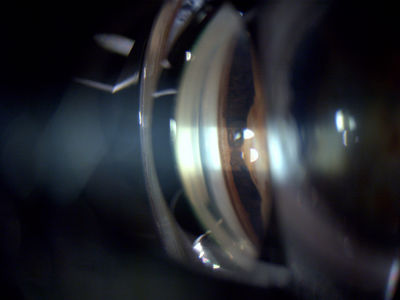 Trauma injury showing iris root detachment - Nasal angle gonio view
Trauma injury showing iris root detachment.  Injury from 20 years ago, has had phaco/IOL.  Nasal angle viewed with a Goldmann 3-mirror goniolens.  Taken with a Topcon - DC1.
Keywords: Gonioscopy; goniolens; gonio; iris root; trauma