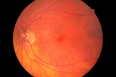 Dry AMD, before it becomes wet
Dry AMD approximately 3 months before becoming wet, taken with a Canon CR6
