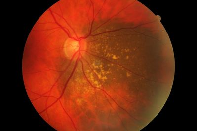 Choroidal Nevus
Choroidal Nevus. Left Eye. Canon CR-6
