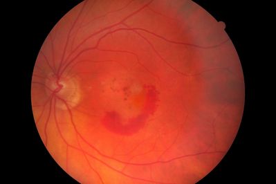 Wet AMD
Wet AMD after 2/12 onset of Sx, taken with a Canon CR6
