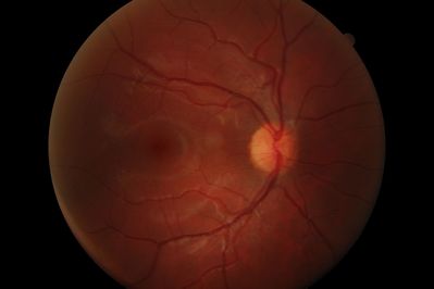 Healthy eye, Papillitis OS.
Onset of Papillitis OS, started 4 days ago.  This is the healthy eye.
Taken with Canon CR-6.  Px is 23yr old WM.
