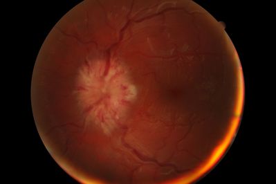 Papillitis OS
Onset of Papillitis OS, started 4 days ago.
Taken with Canon CR-6. Px is 23yr old WM.
