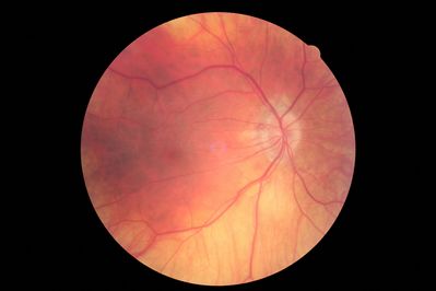 Resolving Disc Haemorrhages
Resolving Disc Haemorrhages. Canon CR-1
