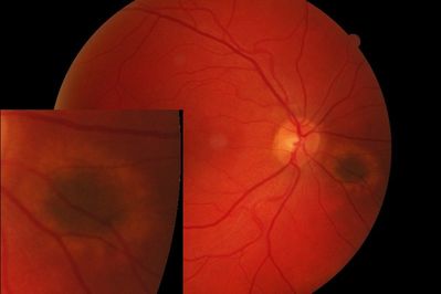 Halo Nevus
Taken with a Canon CR-6.  I have shrunk the main photo, but embedded the full size of the nevus.
