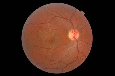 Acute Multifocal Placoid Pigment Epitheliopathy
Retinal scarring from acute inflammation when mid teens. Patient now 36.
