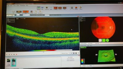 Suspicious naevus in 24 yrs old
Later transformed into melanoma, see next OCT here:
http://www.theoptom.com/gallery/displayimage.php?pid=282&fullsize=1
