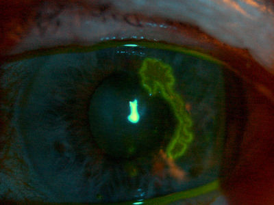 Herpetic ulcer using Topcon 10x DC1 SL camera in a 78 year old female
Left dendritic ulcer after being treated by GP for 2 weeks with ABs. This lady has a history of dendritic ulcers and is 3 months into chemotherapy for ovarian cancer.
Keywords: dendritic; ulcer