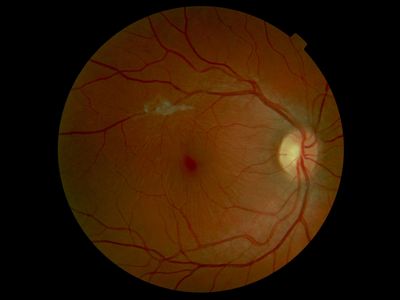 ERM 2' pucker at the vitreous face
35 y/o WF. No sysmptoms. BCVA 20/20-2. Not noted on previous records (probaly because she'd never been dilated)
