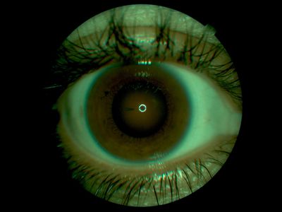 Penetrating corneal stick injury2
Px gardening, bent down and recieved stick injury from Yucca/cactus plant. Endothelium projecting into anterior chamber. (different exposure to injury1)
