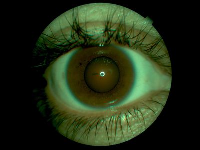 Penetrating corneal stick injury1
Px gardening, bent down and recieved stick injury from Yucca/cactus plant. Endothelium projecting into anterior chamber.
