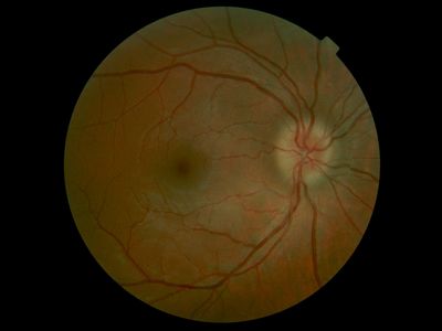 Papilledma OD 29 yo, WF. CC HA on waking
