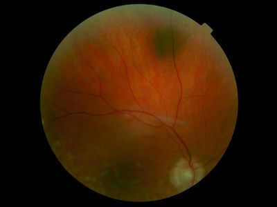 And there it is -- CHRPE
