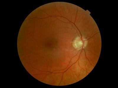 Typical right fundus with atypical 1DD CHRPE above
